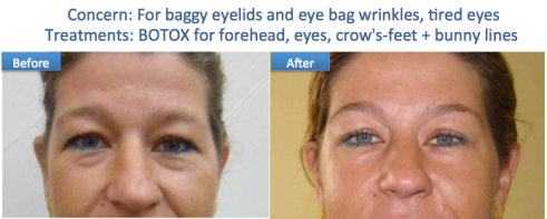 Botox eye bags brow lift anti wrinkle Dr Dulip