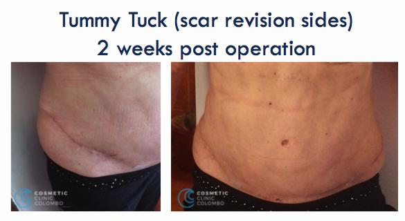 tummy-tuck-scar-revision-surgery – Cosmetic Surgery Sri Lanka
