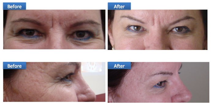BOTOX anti aging wrinkles and creases forehead eyes fine lines Sri Lanka Dr Dulip Dr THushan Colombo