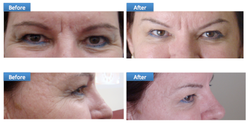 BOTOX anti aging wrinkles and creases forehead eyes fine lines Sri Lanka Dr Dulip Dr THushan Colombo