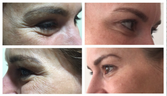 BOTOX for Crows feet, eye bags and hooded eyes and brow lift. Dr Dulip. Dr Thushan