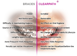 ClearPath Aligners no more braces