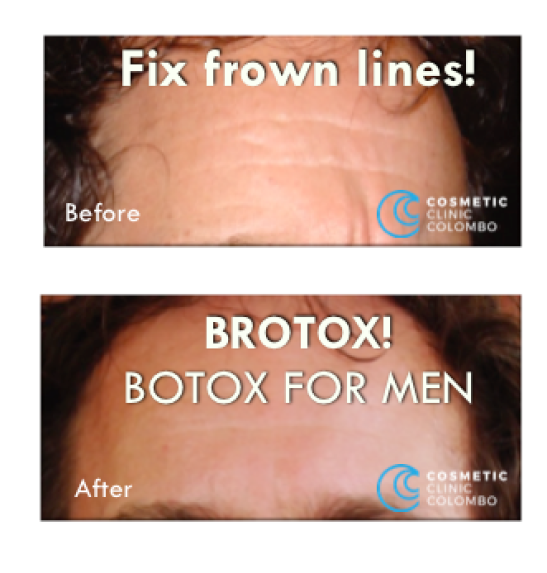Fix Frown lines with tiny injections of BOTOX BRO!