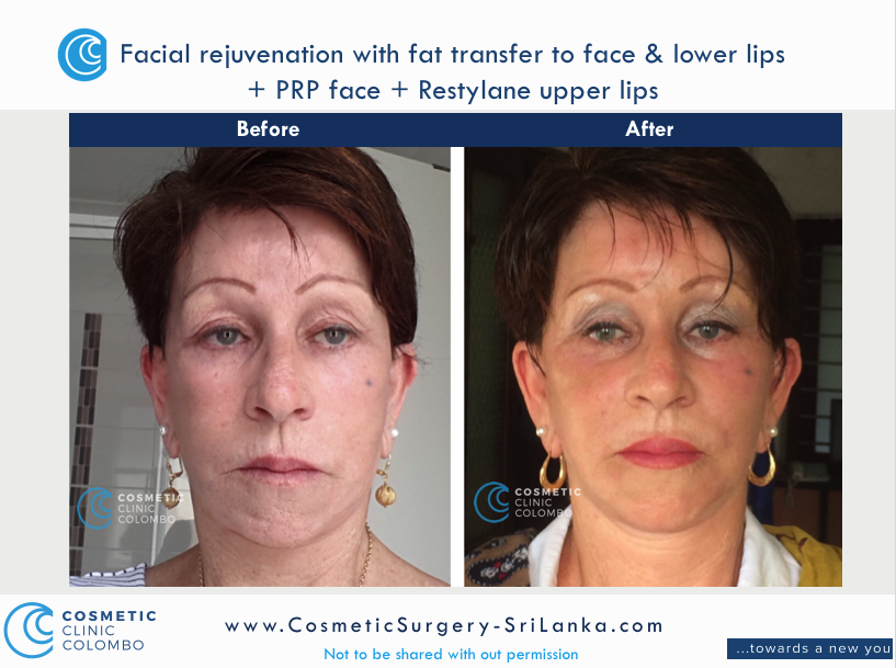 Fat Transfer or fat graft to face and lips dermal lip filler PRP Cosmetic Surgery Sri Lanka