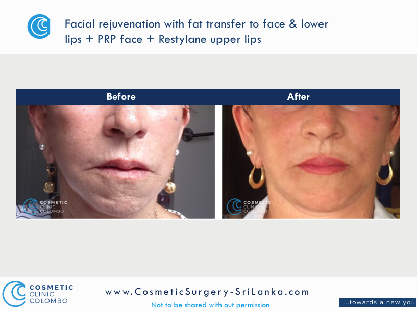 Fat Transfer or fat graft to face and lips dermal lip filler PRP Cosmetic Surgery Sri Lanka