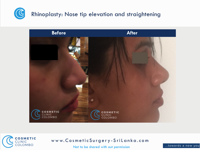 Nose surgery tip elevation and straightening Sri Lanka Rhinoplasty