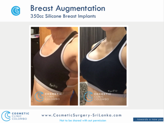 Breast Augmentation Silicone implants Sri Lanka Cosmetic surgery