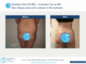 Brazilian Butt Lift Surgery BBL - Beautiful C shape buttocks - Cosmetic Surgery Sri Lanka