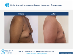 Male Breast Reduction Male Breast Reduction Gyneacomastia Gynecomastia Dr Thushan Sri Lanka Cosmetic Surgery Moobs.