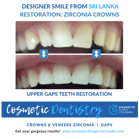 Dental Sri Lanka Crowns Teeth Whitening