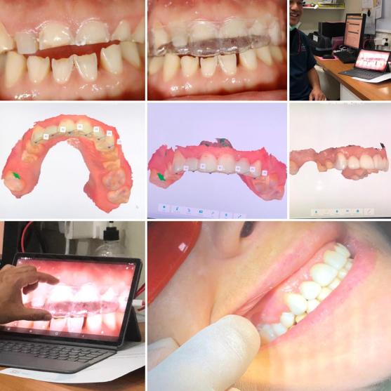 Digital Dental Malaysia zirconia crowns implants